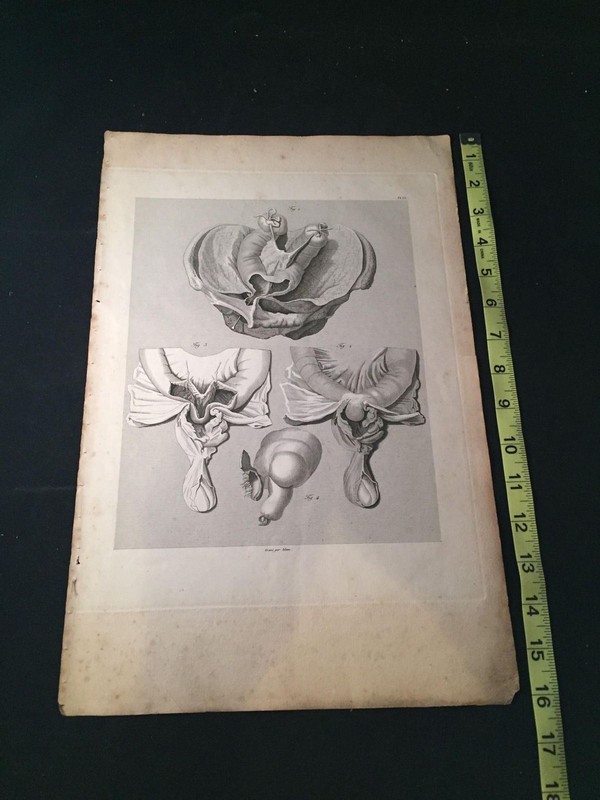 RARE 1823 10X16 Medical Engraving LAID PAPER Antonio Scarpa HERNIA Male Parts